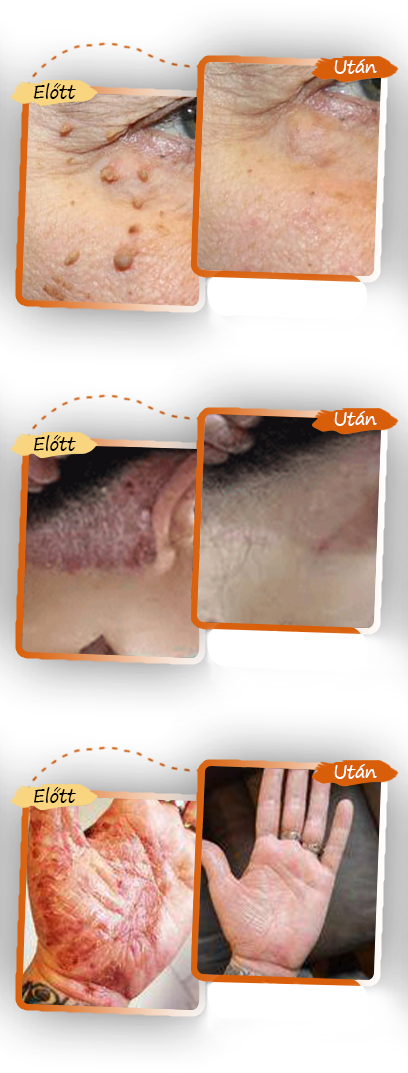 ✨ Pureluxo® Fekete Rizses Bőrregeneráló Krém 👨⚕️ (Szemölcsök, bőrkinövések, foltok és hiperpigmentáció kezelésére)