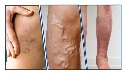 ✅Healrize® Vénacélpont mikrotűs tapasz⚡Azonnali enyhülés hosszú távú eredmények