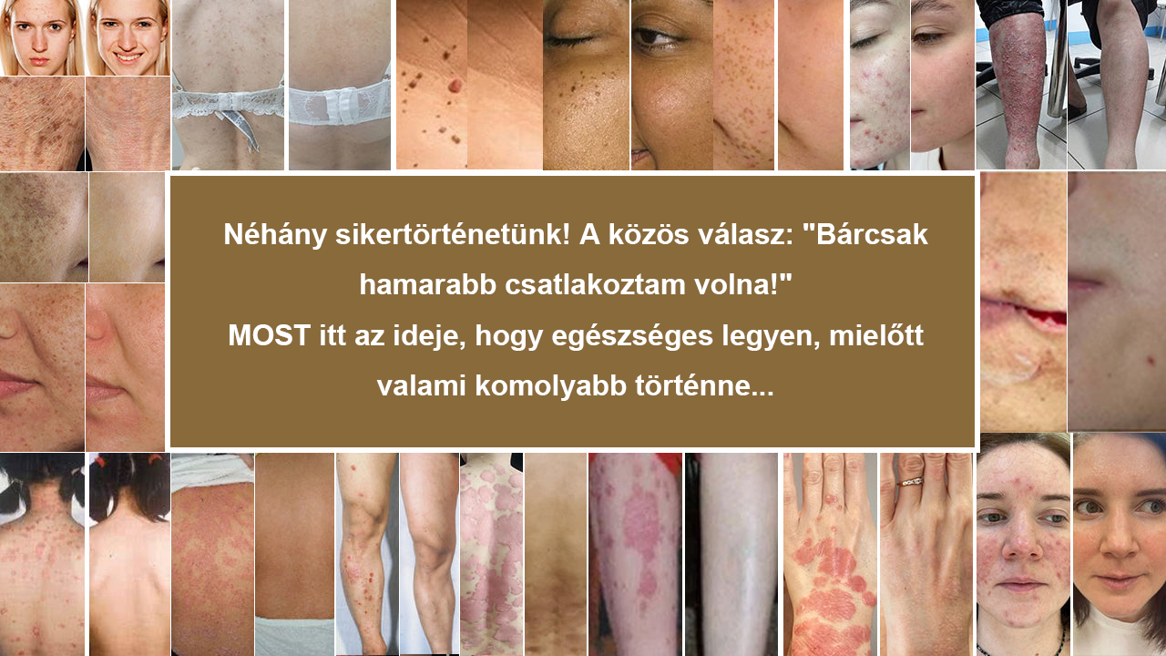 ✨ Pureluxo® Fekete Rizses Bőrregeneráló Krém 👨‍⚕️ (Szemölcsök, bőrkinövések, foltok és hiperpigmentáció kezelésére)
