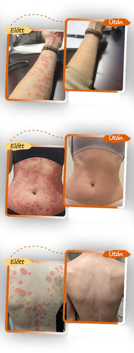 ✨ Pureluxo® Fekete Rizses Bőrregeneráló Krém 👨‍⚕️ (Szemölcsök, bőrkinövések, foltok és hiperpigmentáció kezelésére)