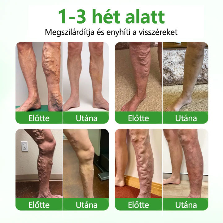 💡Laleia® VeinHeal mikrotűs tapasz
