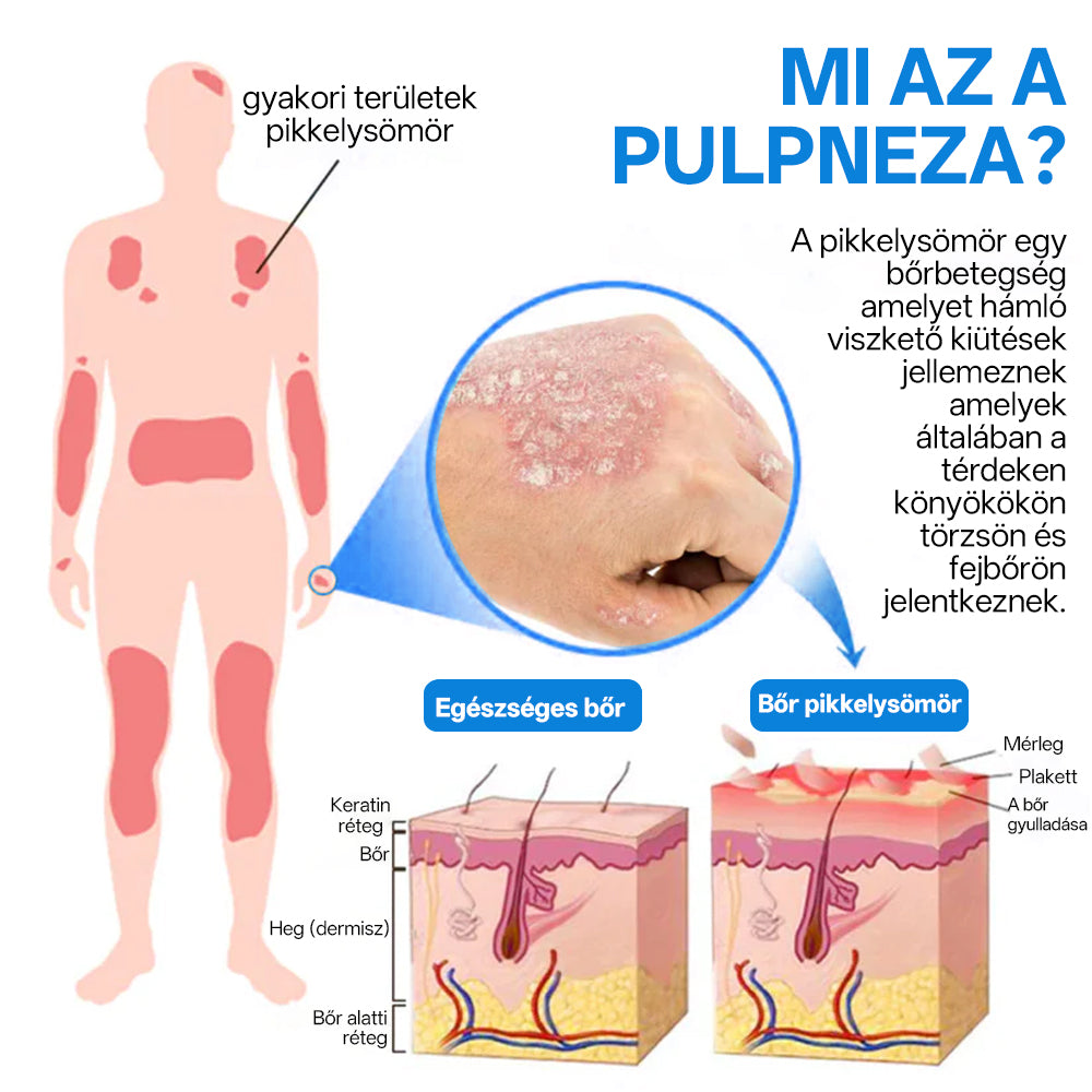 ✅ Hivatalos bolt: Zvoevo® Magnéziumos gyógynövényes spray pikkelysömörre ⚕️ MHRA tanúsítvánnyal (enyhíti a pikkelysömört, ekcémát, kezeli pattanásokat, szemölcsöket, javítja bakteriális fertőzéseket)