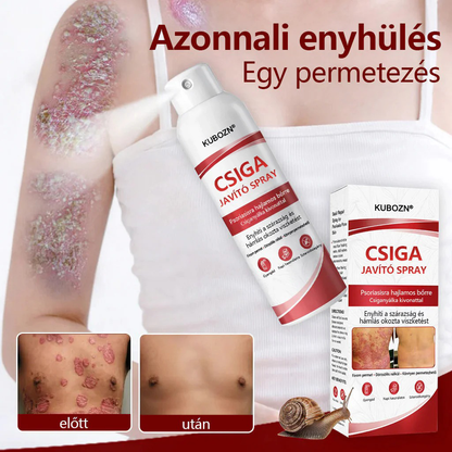 💡KUBOZN®  csigahéjas spray viszkető, hámló pikkelysömörös bőrre