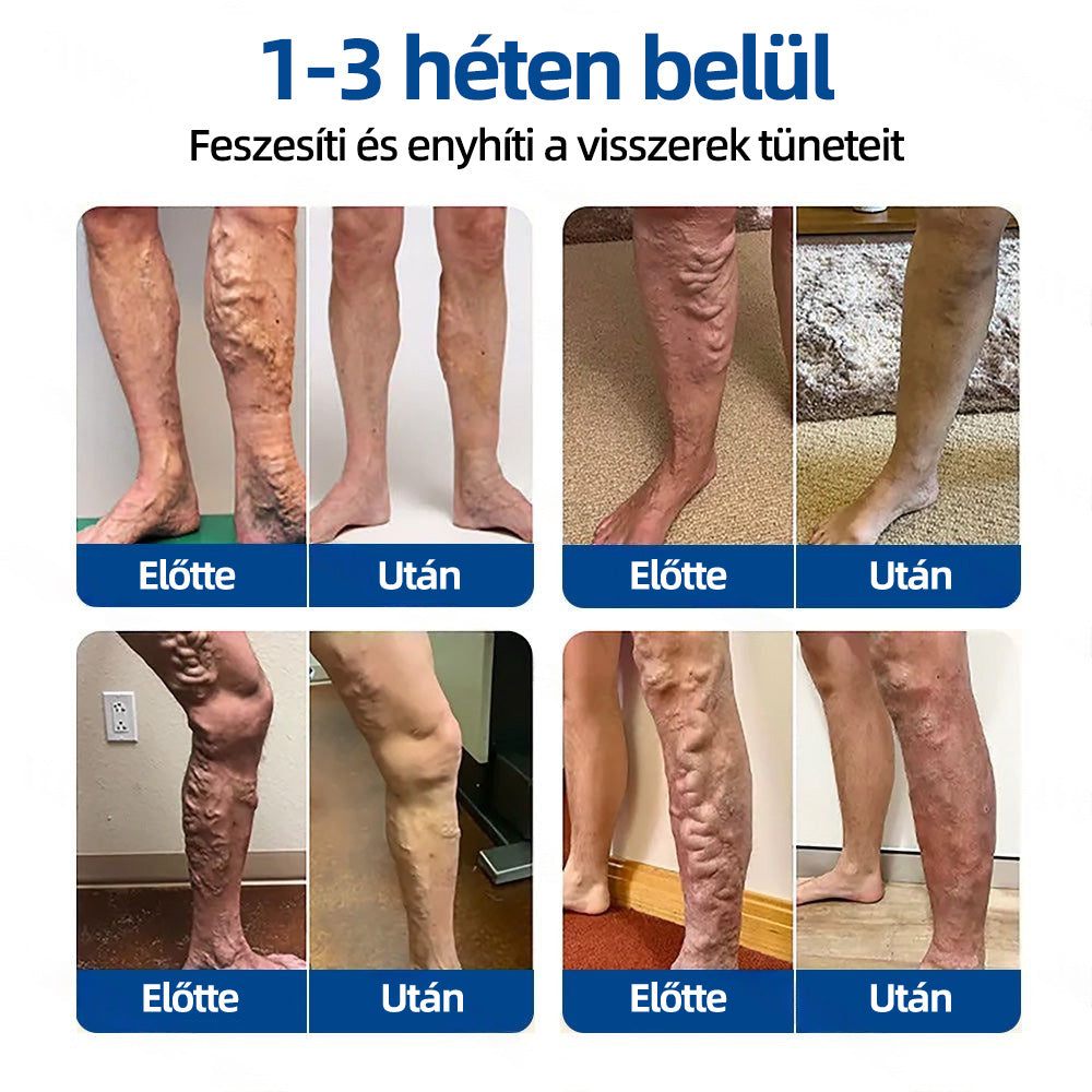 ✅Healrize® Vénacélpont mikrotűs tapasz⚡Azonnali enyhülés hosszú távú eredmények