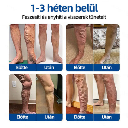 ✅Healrize® Vénacélpont mikrotűs tapasz⚡Azonnali enyhülés hosszú távú eredmények