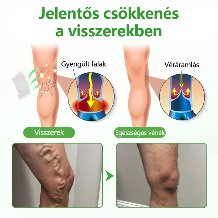 💡Laleia® VeinHeal mikrotűs tapasz