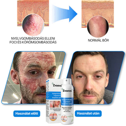 ✅ Hivatalos bolt: Zvoevo® Magnéziumos gyógynövényes spray pikkelysömörre ⚕️ MHRA tanúsítvánnyal (enyhíti a pikkelysömört, ekcémát, kezeli pattanásokat, szemölcsöket, javítja bakteriális fertőzéseket)