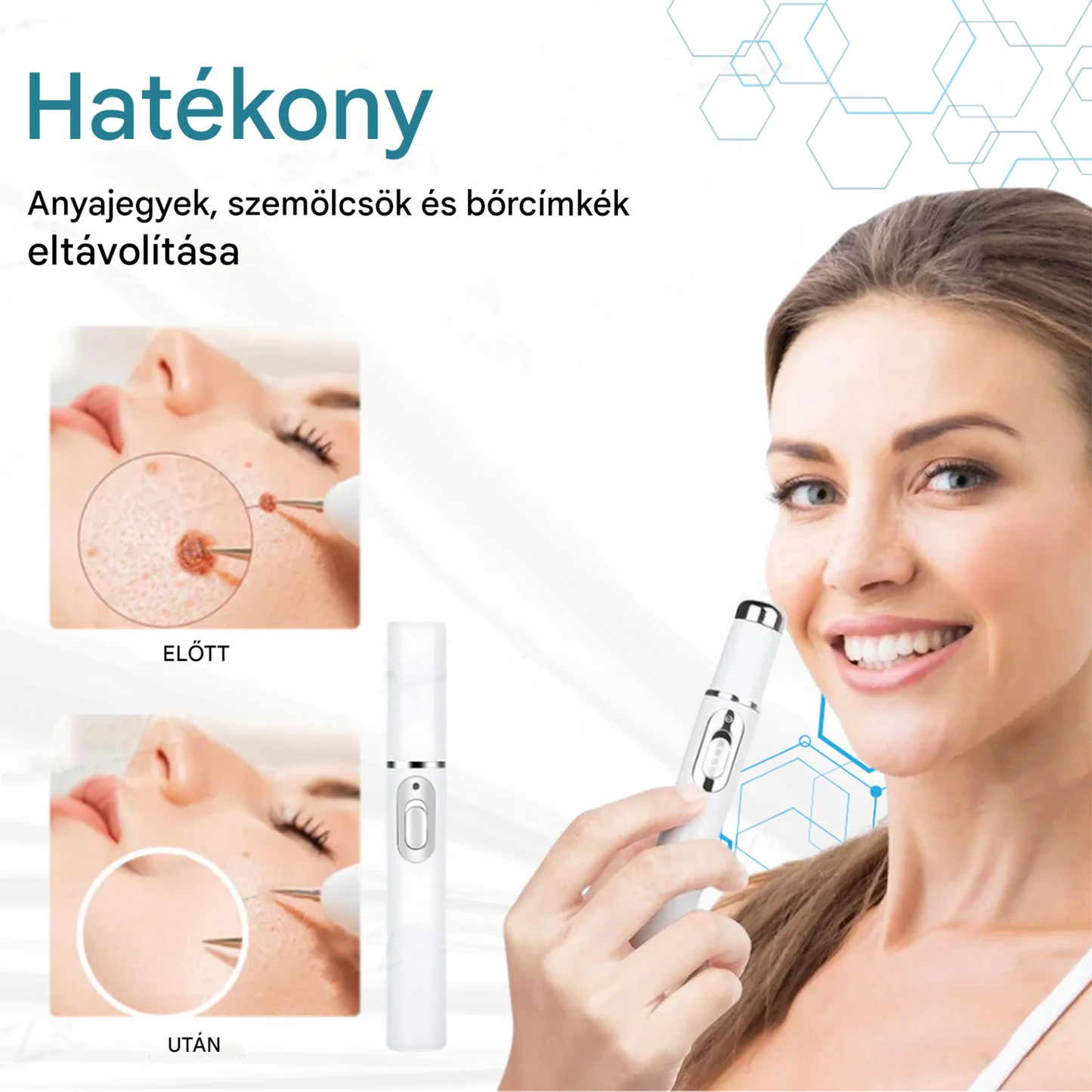 Pureluxo® non-invazív anyajegy- és szemölcseltávolító lézertoll✨