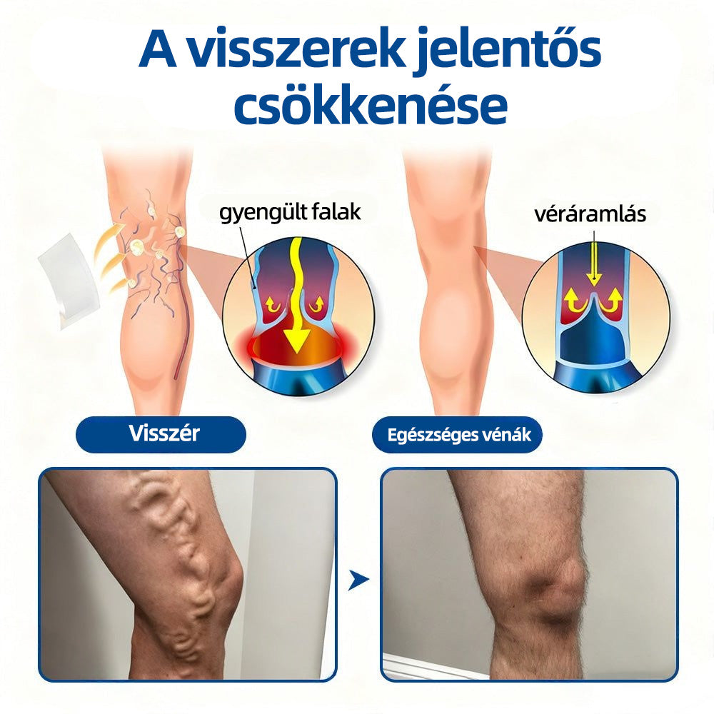 ✅Healrize® Vénacélpont mikrotűs tapasz⚡Azonnali enyhülés hosszú távú eredmények