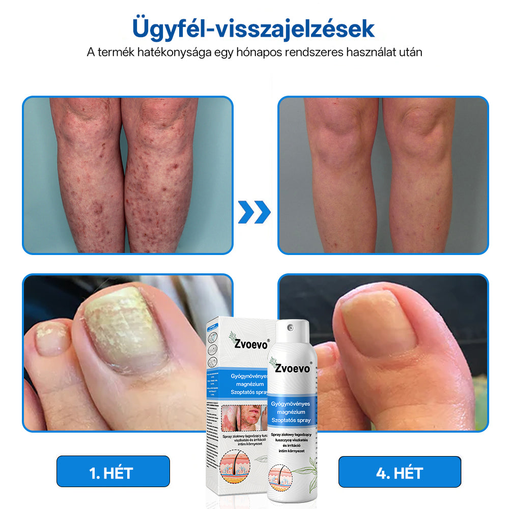 ✅ Hivatalos bolt: Zvoevo® Magnéziumos gyógynövényes spray pikkelysömörre ⚕️ MHRA tanúsítvánnyal (enyhíti a pikkelysömört, ekcémát, kezeli pattanásokat, szemölcsöket, javítja bakteriális fertőzéseket)