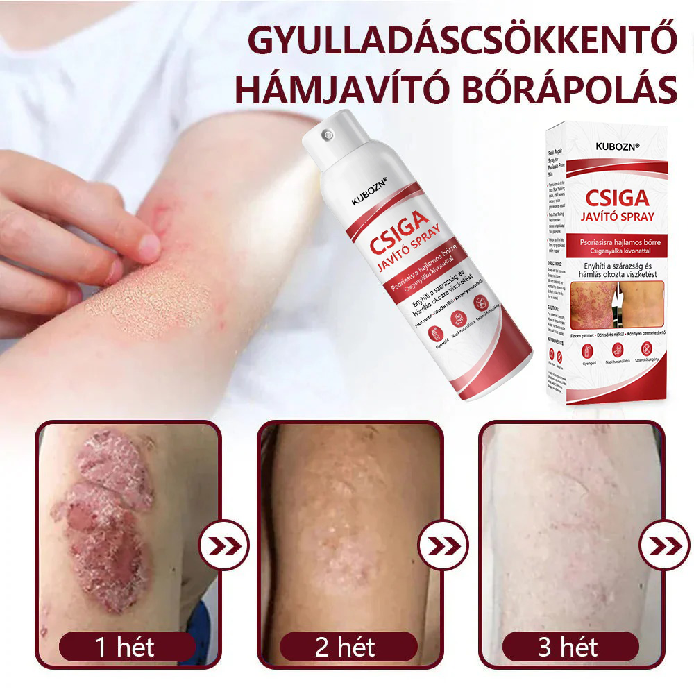 💡KUBOZN®  csigahéjas spray viszkető, hámló pikkelysömörös bőrre