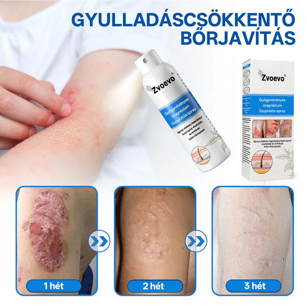 ✅ Hivatalos bolt: Zvoevo® Magnéziumos gyógynövényes spray pikkelysömörre ⚕️ MHRA tanúsítvánnyal (enyhíti a pikkelysömört, ekcémát, kezeli pattanásokat, szemölcsöket, javítja bakteriális fertőzéseket)