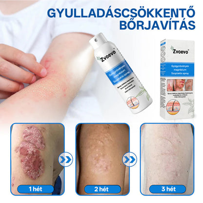 ✅ Hivatalos bolt: Zvoevo® Magnéziumos gyógynövényes spray pikkelysömörre ⚕️ MHRA tanúsítvánnyal (enyhíti a pikkelysömört, ekcémát, kezeli pattanásokat, szemölcsöket, javítja bakteriális fertőzéseket)